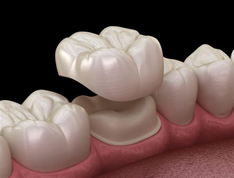 Complete Dental Crown Guide Cost Procedures And Types