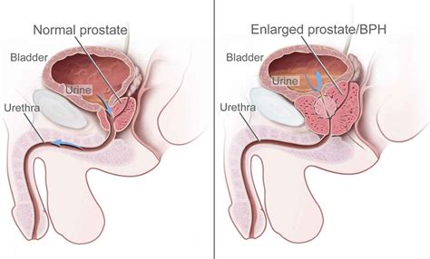 Prostate Health And Benign Prostatic Hyperplas Shield HealthCare