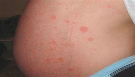 Red Spots On Chest And Stomach Not Itchy At Shirley Simmons Blog