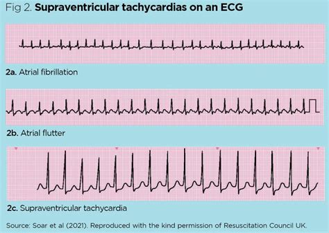 Ventricular Tachycardia