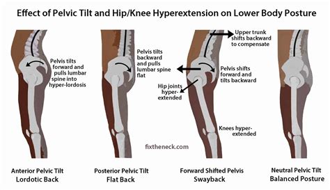 Posterior Pelvic Tilting Even Simpler Post Competitive Insight