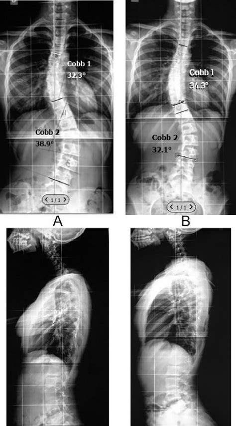 Spinograms A Anteroposterior And Lateral Scoliosis Series Before