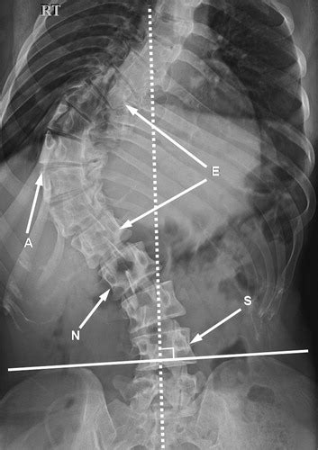 Scoliosis X Ray Before And After