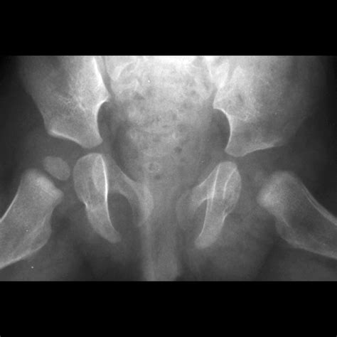 Developmental Dysplasia Of The Hip Pediatric Radiology Reference