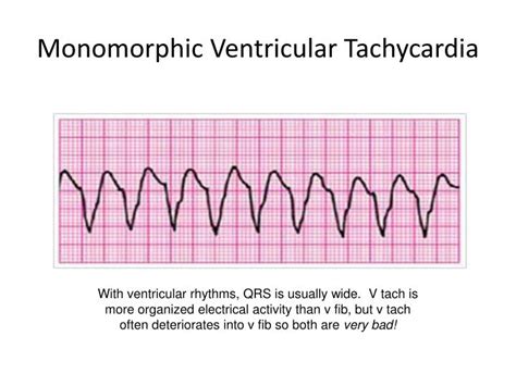 Mono Vs Poly Ventricular Tachycardia