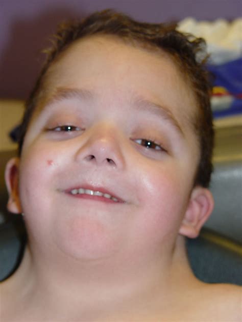 Noonan Syndrome Causes Symptoms Prognosis Treatment