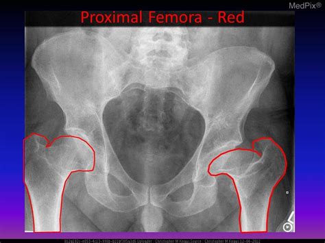 Congenital Hip Dysplasia Xray