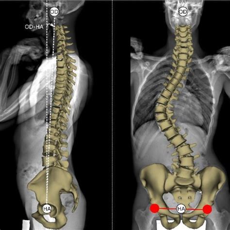 Scoliosis Pelvic Tilt