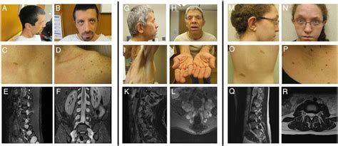 Patient 1 At Age 28 Years Noonan Like Facial Features A And B