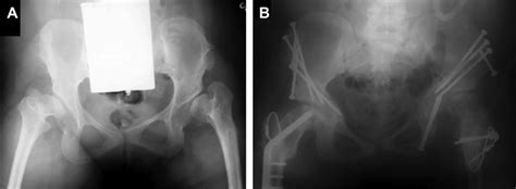 Hip Preservation Paley Orthopedic And Spine Institute