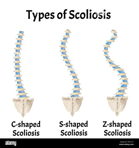 Xray Versus Eos For Scoliosis Schroth Scoliosis