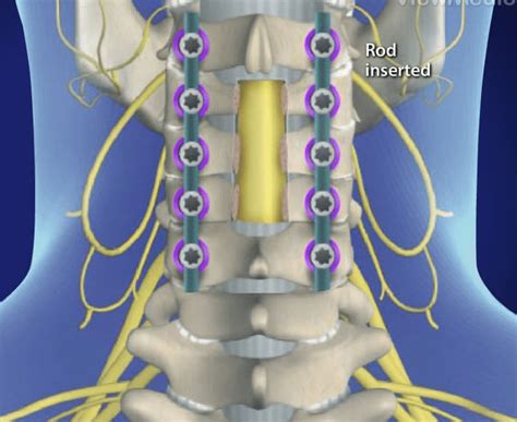 Laminectomy Procedure Florida Surgery Consultants