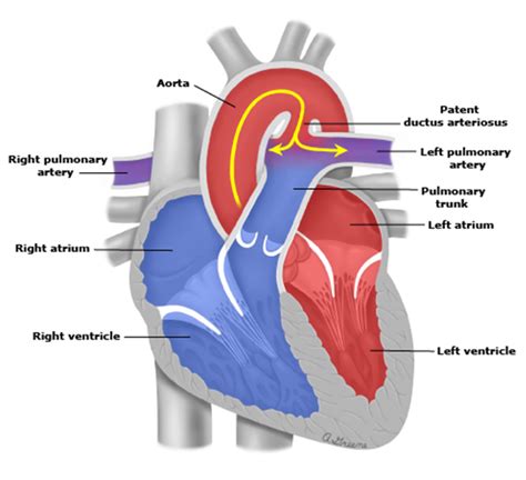 Patent Ductus Arteriosus My Path