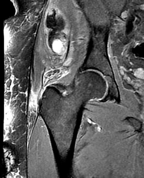 Acute Traumatic Tear Of Gluteus Medius And Minimus Tendons In A Patient