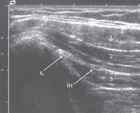 Ilioinguinal And Iliohypogastric Nerves Cannot Be Selectively Blocked