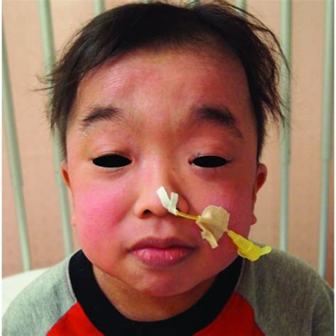 Facial Features Of Noonan Like Syndrome The Patient Had Characteristic