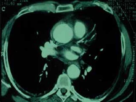 Contrast Enhanced Ct Scan Of The Ascending Aorta An Aortic Intramural