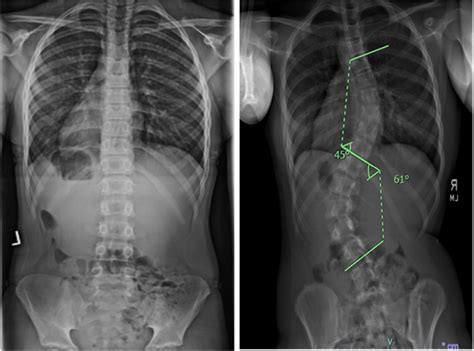 Radiographs Of Children With A Normal Spine Left And Severe