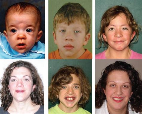 The Face Of Noonan Syndrome Does Phenotype Predict Genotype