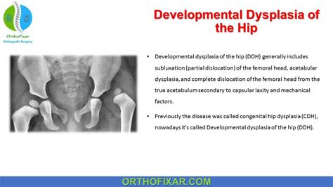 Developmental Dysplasia Of The Hip Orthofixar 2024