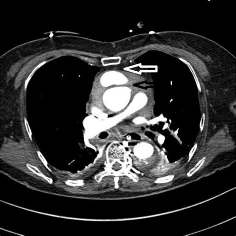 Ascending Aorta Ct Scan Porn Sex Picture