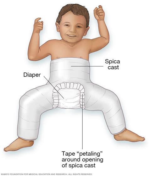 Hip Dysplasia Diagnosis And Treatment Mayo Clinic