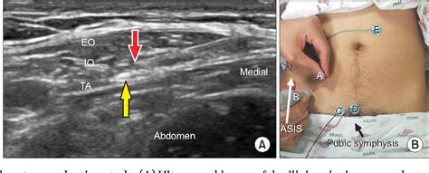 Figure 2 From Diagnosis Of Ilioinguinal Nerve Injury Based On