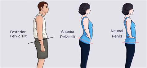 Posterior Pelvic Tilt Causes Symptoms And Treatment