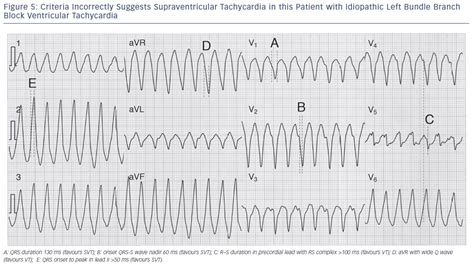 Difference Between Ventricular Tachycardia And Svt