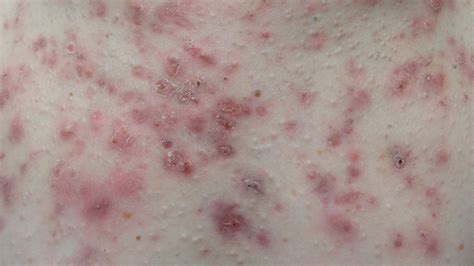 Raised Skin Bumps Causes Symptoms And Treatment On Them Mi Uk