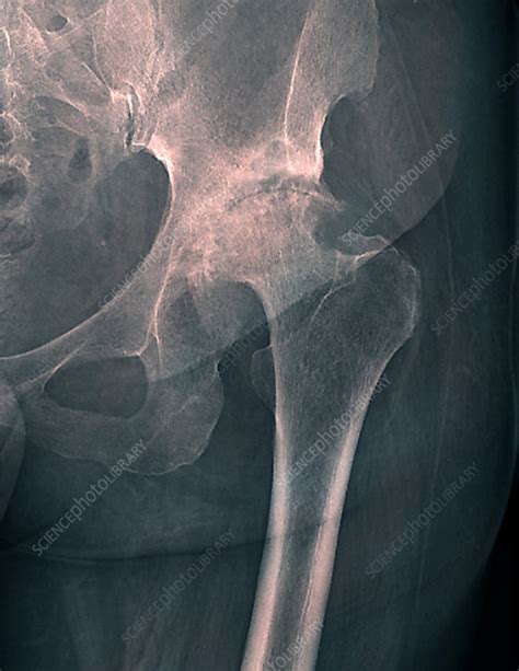 Abnormal Hip X Ray