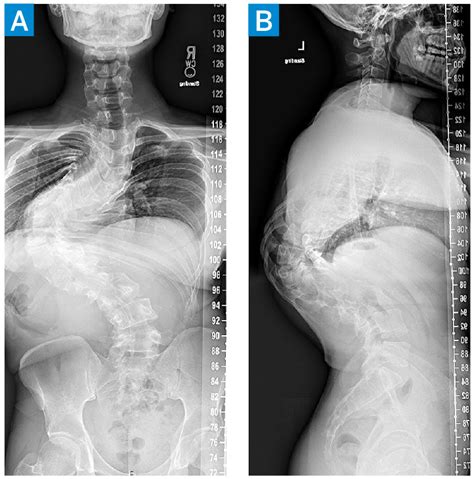 Correction Of Severe Congenital Scoliosis Hss Case