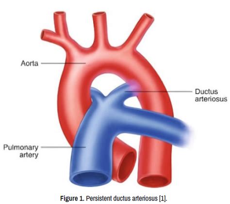 Vasculitis Arteriosus