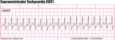 Ecg Educator Blog Supraventricular Tachycardia Svt