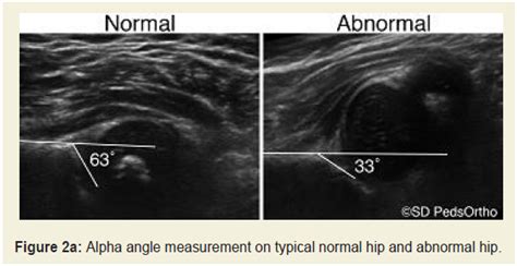 Avens Publishing Group Does A Normal Hip Ultrasound At 3 6 Months Of