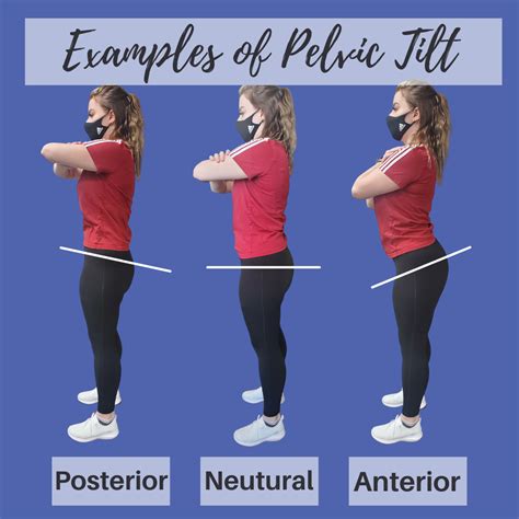 Do You Have A Pelvic Tilt Activecare Physio