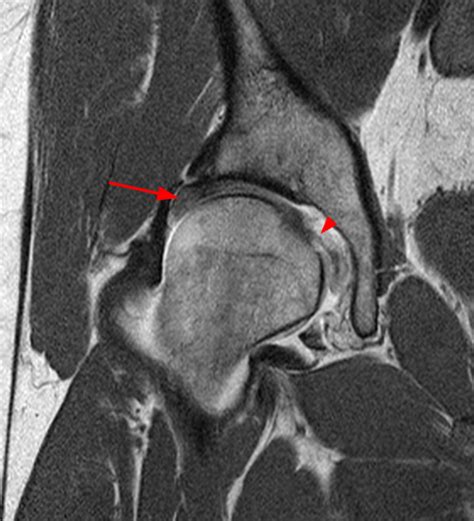 Congenital Hip Dysplasia Xray