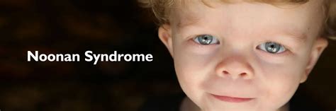 Noonan Syndrome Causes Symptoms Diagnosis Treatment