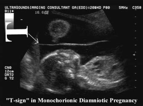 Most relevant best selling latest uploads. Nagendra's Radiology Blog: RADIOLOCY MCQ--Sunburst sign ...