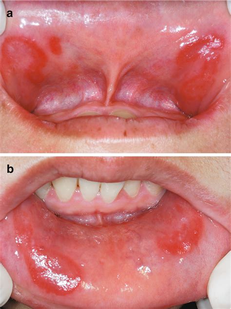 Syphilis is divided into stages: Syphilis Face : Girl Showing The Effects Of Congenital ...