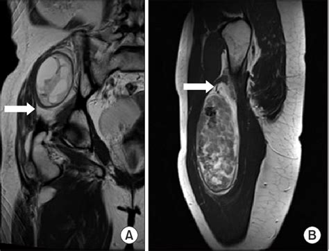 A Coronal T2 Weighted Magnetic Resonance Imaging Mri Of An