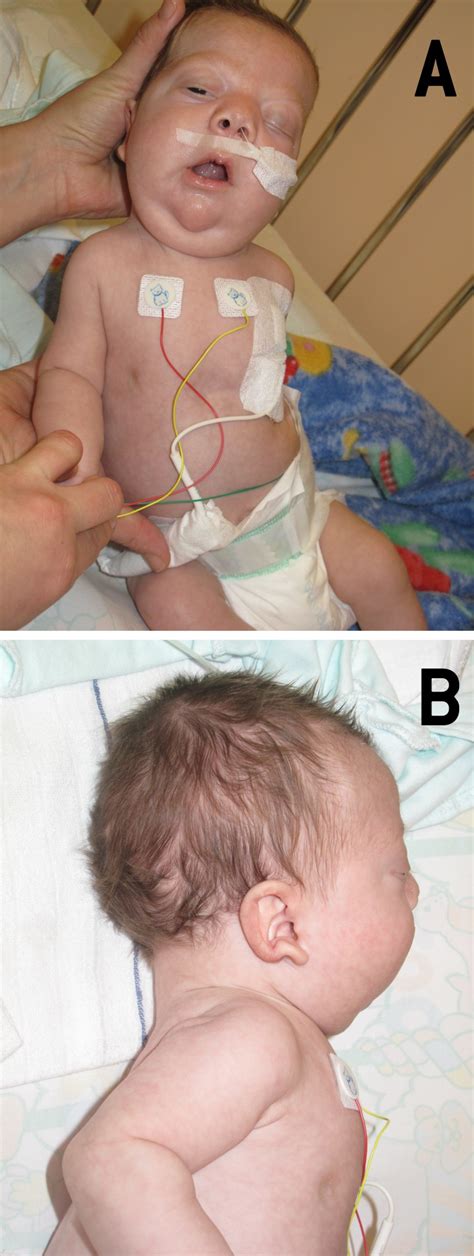 Dysmorphic Features Of The Patient With Noonan Syndrome At The Age Of 3