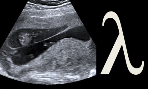 An unnamed function object capable of capturing variables in scope. Radiology Signs • Lambda sign - describes the triangular ...