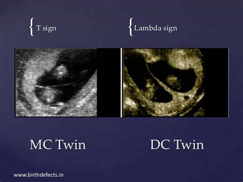 Lambda (as c) is a constant, often a real its a constant sign, this alphabets always don't give you a single information, it varies from field to field. Twin pregnancy....a journey.....