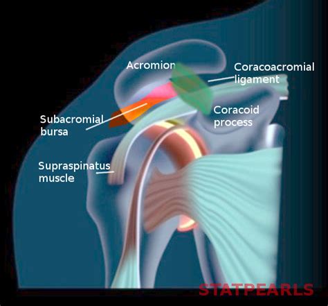 Subacromial Bursitis StatPearls NCBI Bookshelf