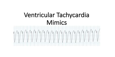 Ventricular Tachycardia Vs Ventricular Fibrillation