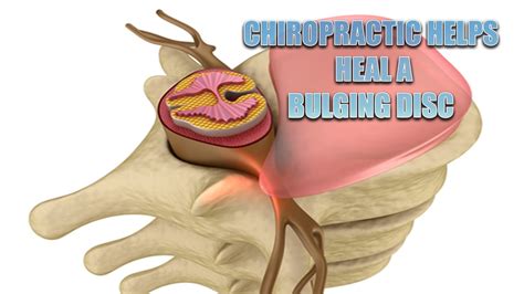 Heal A Bulging Disc Through Chiropractic El Paso TX