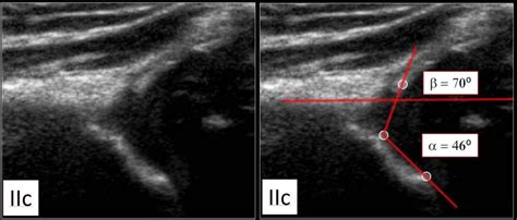 The Radiology Assistant Developmental Dysplasia Of The Hip