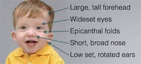 Causes Of Noonan Syndrome MEDizzy