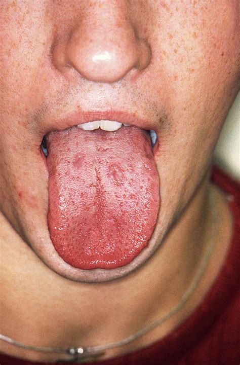 Syphilis spreads from person to person via skin or mucous. Syphilis In The Mouth Photograph by Cdc/science Photo Library